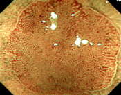 NBIと拡大機能を併用した大腸腺腫の観察像例